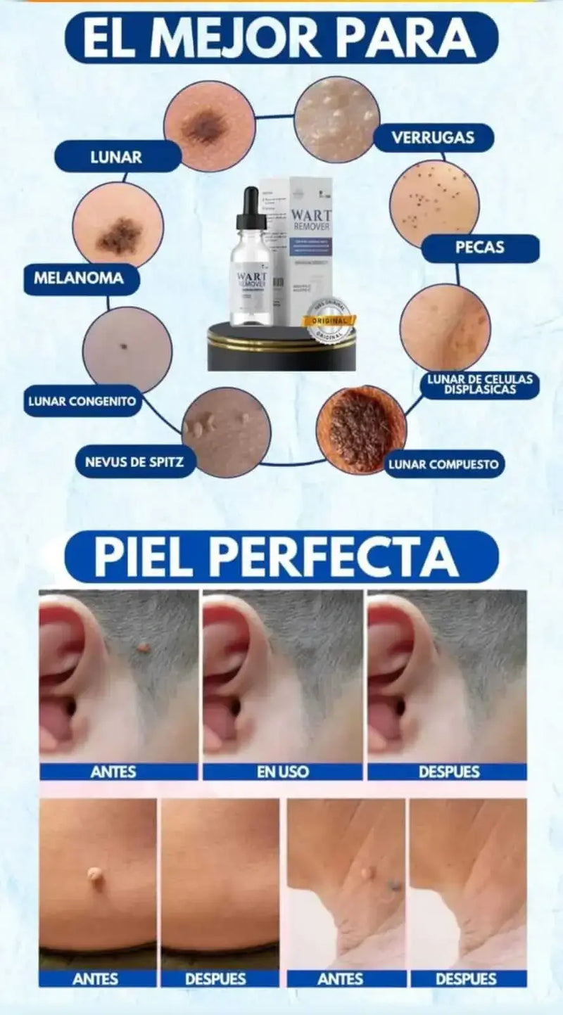 Wart Remover™ Elimina verrugas sin dolor desde casa